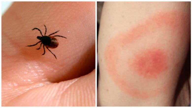 tick-bite.jpg